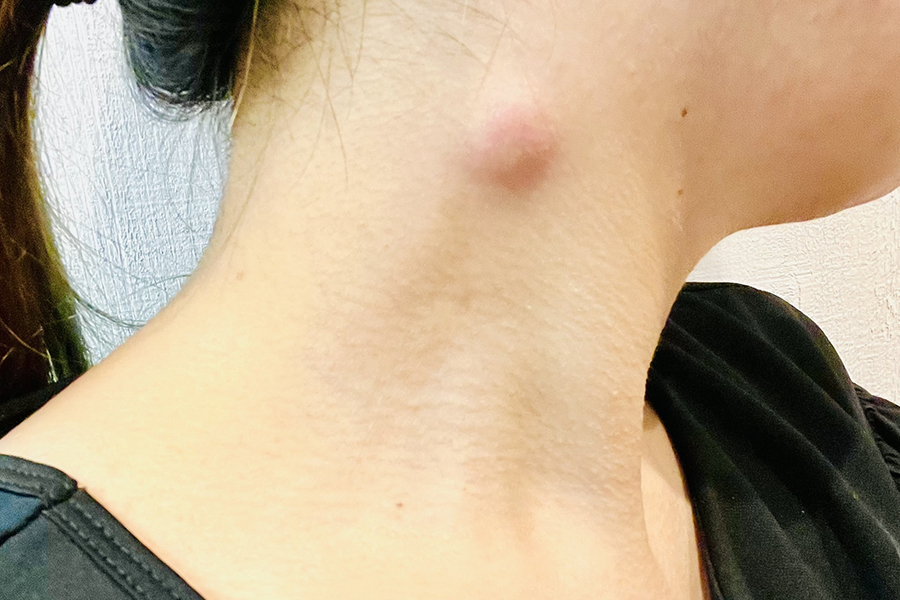粉瘤（アテローム）とは？症状と治療方法
