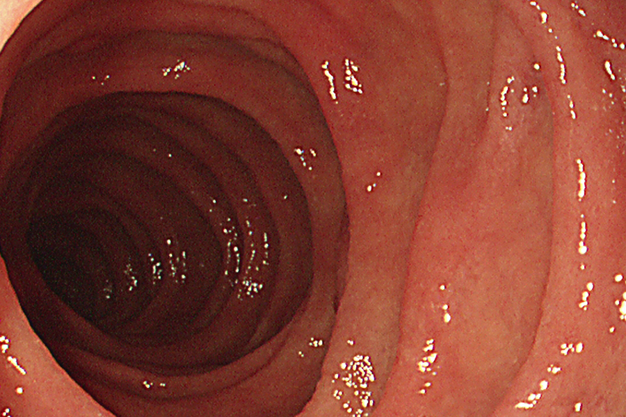 大腸カメラ検査でわかること