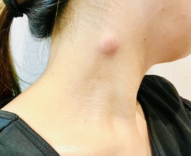 日帰り手術で安心！粉瘤・皮膚腫瘤の治療ガイド